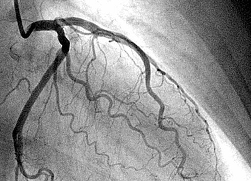 coronary-angiography
